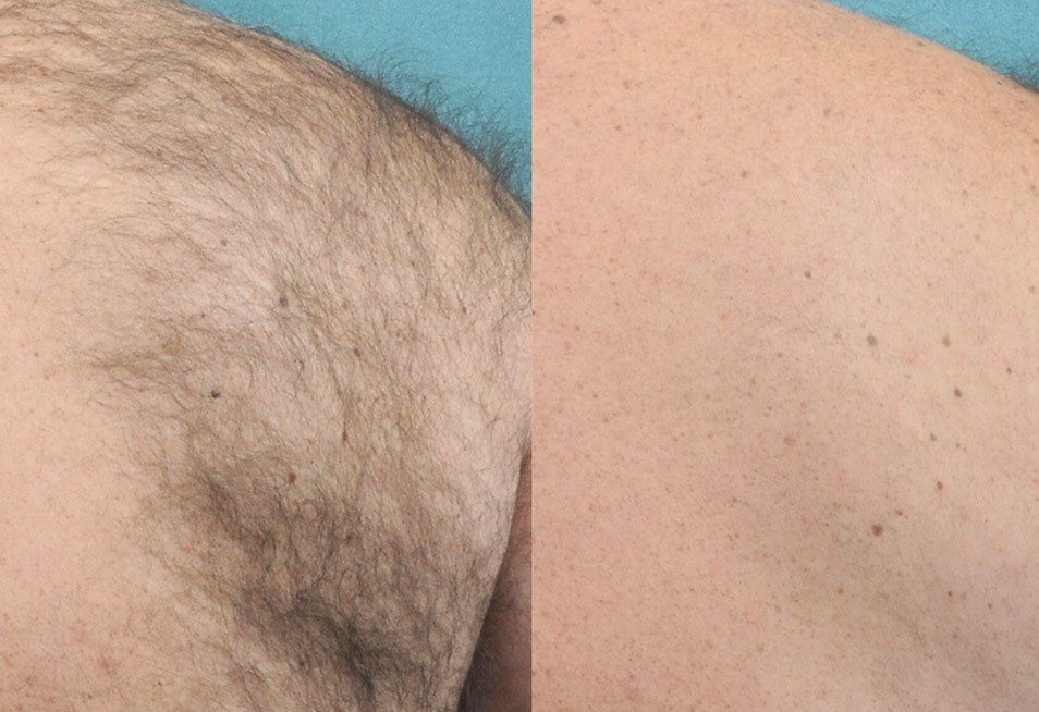 Before and after laser hair removal — back area showing significant hair reduction