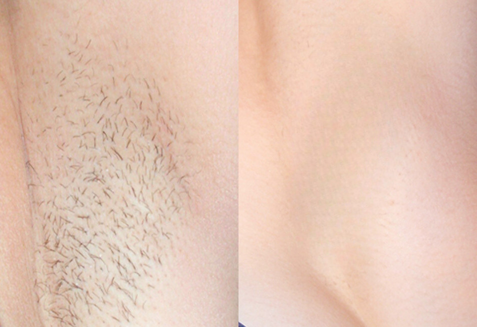 Before and after laser hair removal — underarm area showing smooth, hair-free results